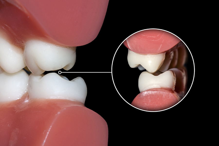 歯ぎしり、顎関節症の症状について